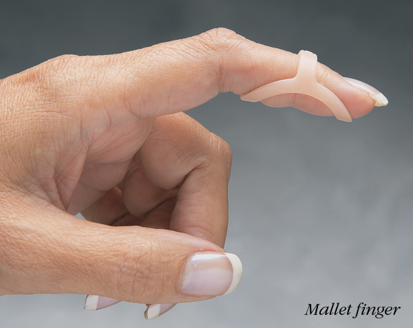 Oval-8™ Finger Splints